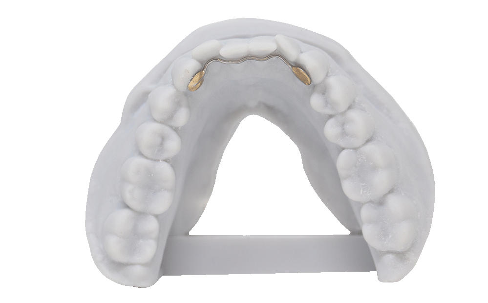 Russellville Dental Lab Lower Lingual Retainer
